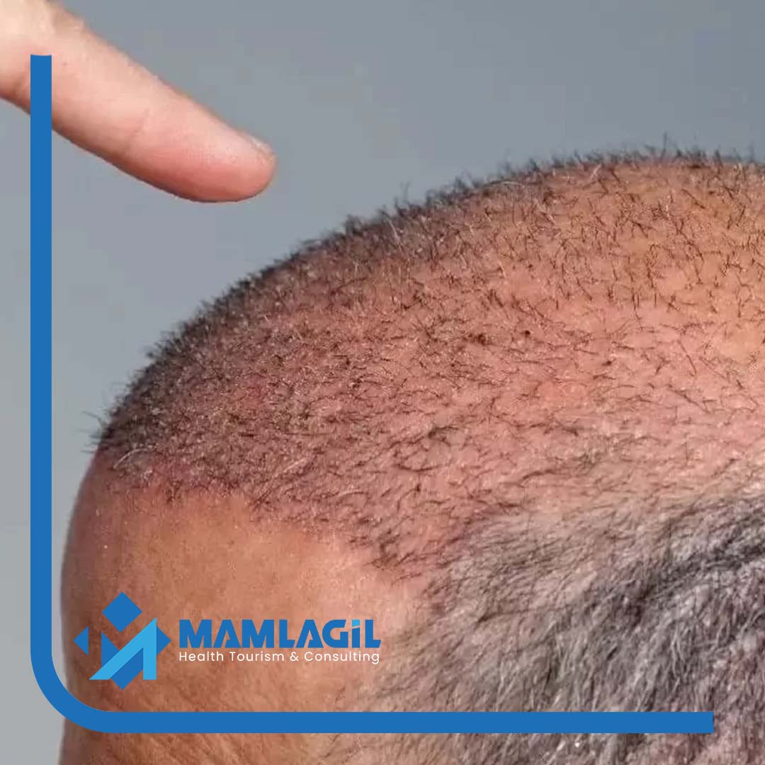 Mamlagil Saç Foto - 4